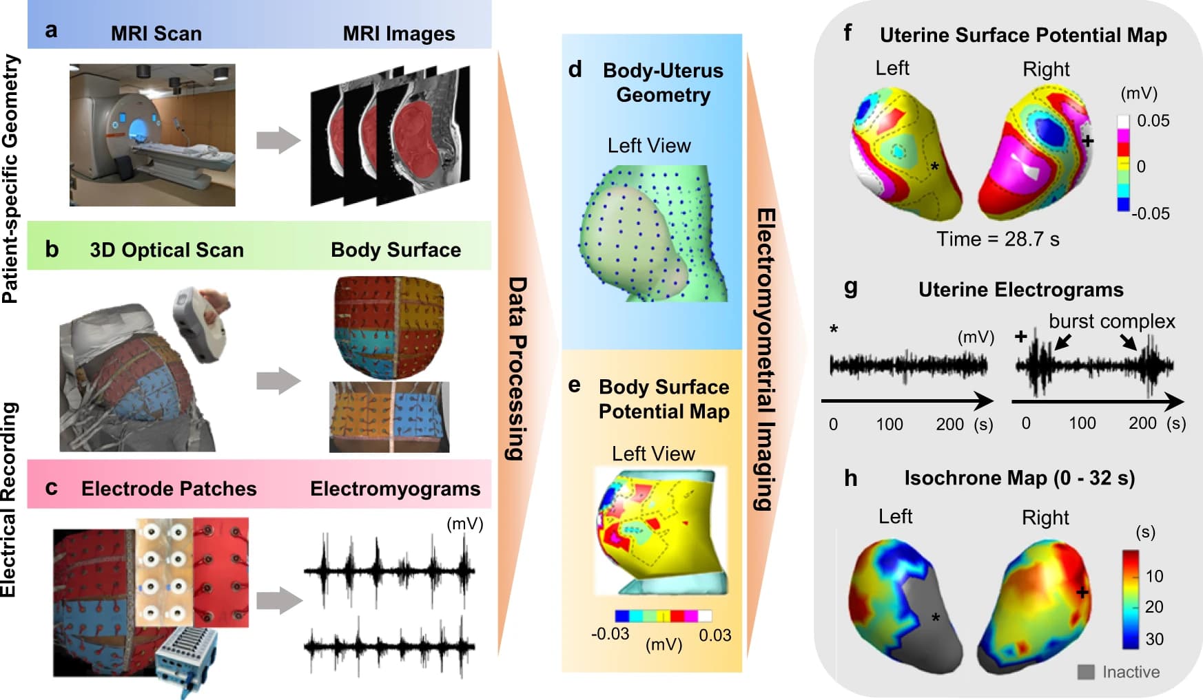 Elektromyometrisches Bildgebungsverfahren von Wehen. Quelle: Wang et al. (2023) “Noninvasive electromyometrial imaging of human uterine maturation during term labor”.